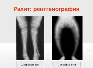 Норма и патология ядер окостенения тазобедренных суставов Норма развития по месяцам