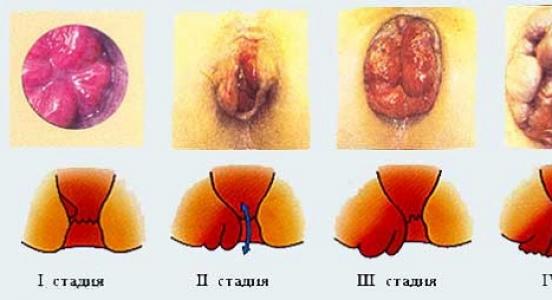 Znakovi hemoroida kod muškaraca, simptomi i liječenje